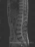 脊椎領域MRI画像