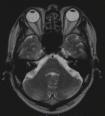 頭部領域MRI画像